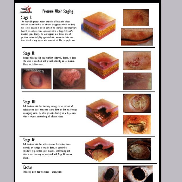 Wound stages | Pressure ulcer staging, Nursing study, Pressure ulcer