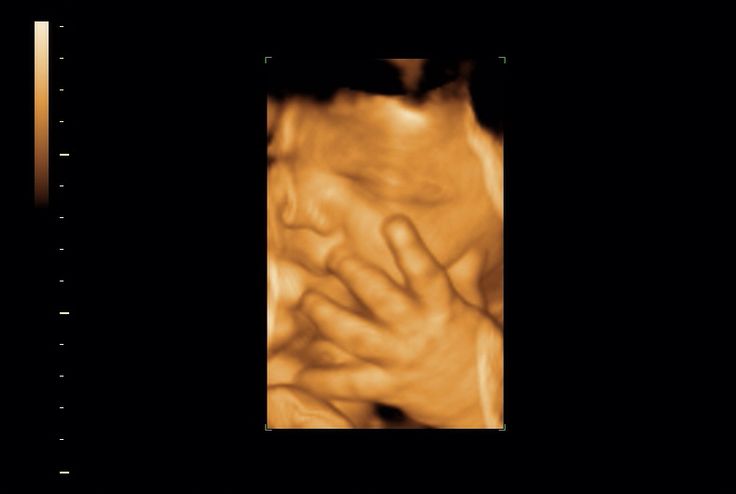 hair on a 3d ultrasound