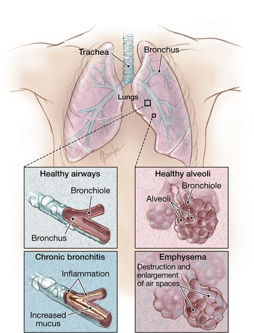 Cambios anatómicos pulmonares en pacientes con EPOC (JAMA) (anatomic pu ...