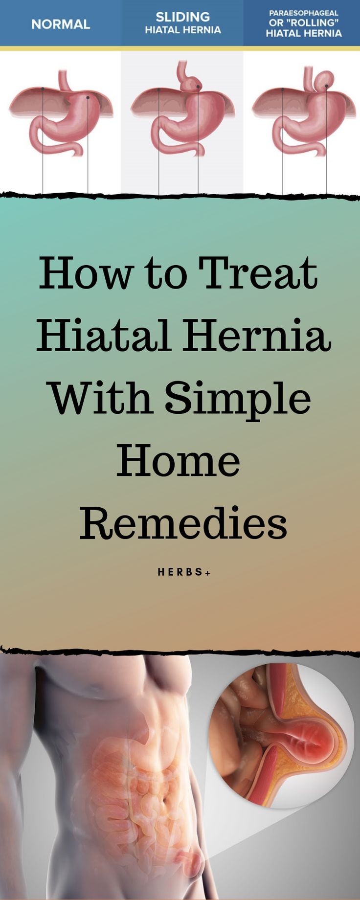 If you are reading this article then you are looking for treatments and remedies for Hiatal hernia. But to know about and understand the remedies of the problem you will first have to understand what is Hiatal hernia, its types and causes and symptoms  #hernia #health #disease #remedies #homeremedies #healthyliving #medicine #healthcare Health Disease, Holistic Remedies, Holistic Medicine, Simple Home, Natural Home Remedies, Natural Treatments, Healthy Living Tips, Alternative Medicine, Simple House