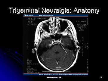 an mri scan with the words'trigemina neuragina anatomy '