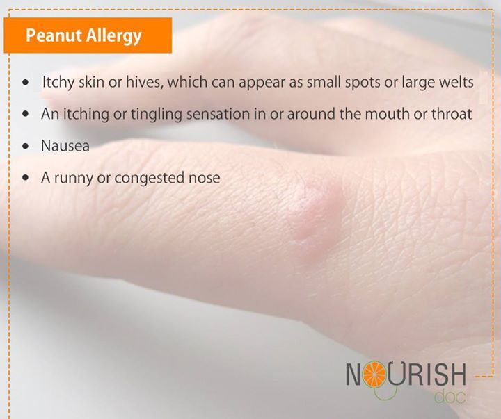 Peanut Allergy is a food allergy that affects the body as a reaction after eating peanuts. Some of the symptoms are: Peanut Allergy Tattoo, Food Allergy Rash, Allergy Rash, Nut Allergy Awareness, Peanut Allergy Sign, Soy Allergy Avoidance List, Congested Nose, Peanut Allergy, Nutritious Diet