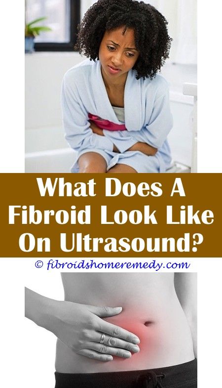 10 Cm Fibroid