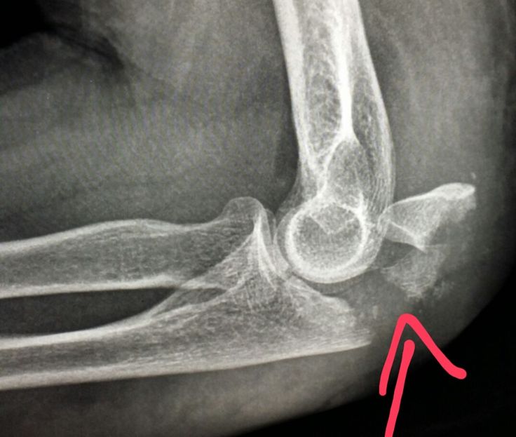 #Elbow #xray shows a #fracture of the #ulna (#olecranon) in a #patient who #fell.  #radiologist #radiology #trauma #pain Elbow Xray, Xray School, Studying Nursing, Radiology Schools, Xray Humor, Radiology Technician, Forensic Anthropology, Nuclear Medicine, Xray Tech