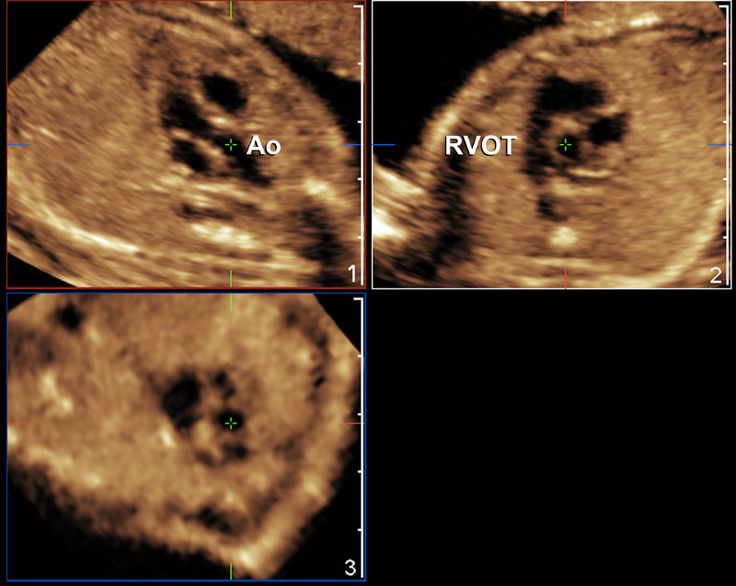 Volumetric Imaging of the Fetal Heart | Ultrasound sonography ...