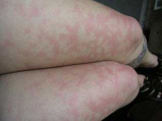 Do you have blotchy skin on your legs? Hawk Tattoos, Red Blotchy Skin, Easy Baklava, Poison Ivy Rash, Spiders Repellent, Rash Causes, German Star, Hawk Tattoo, Biology Worksheet