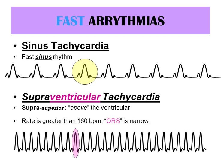 EKG Review. - ppt video online download in 2023 | Nursing school notes ...