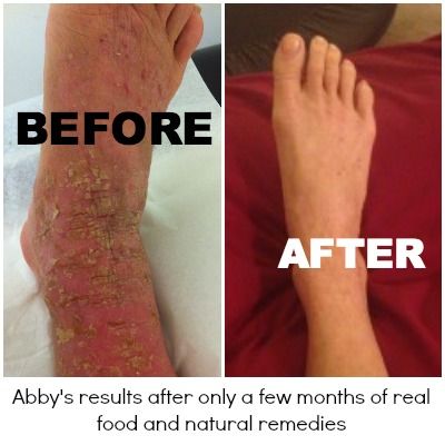 Abby's Eczema Before and After - Healing Eczema Naturally Vertical Aquaponics, Healing Smoothie, System Design, Aquaponics System, Beauty And Health, Natural Treatments, Natural Remedies, Health Tips, New Jersey