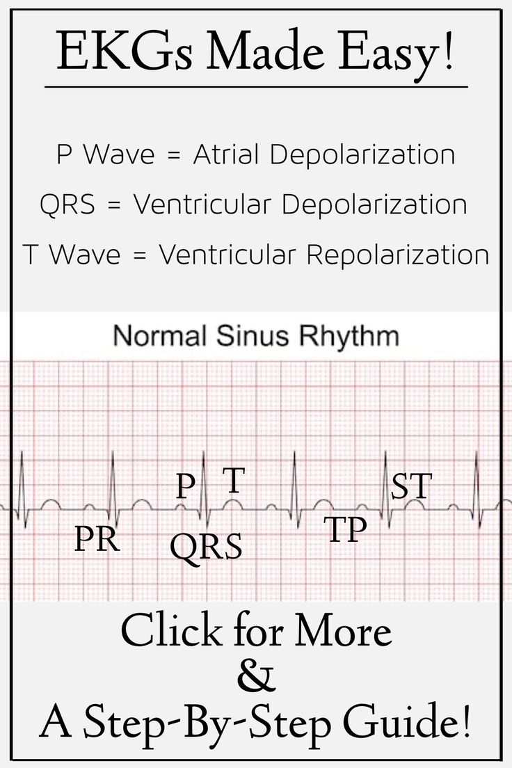 Printable Ekg Cheat Sheet