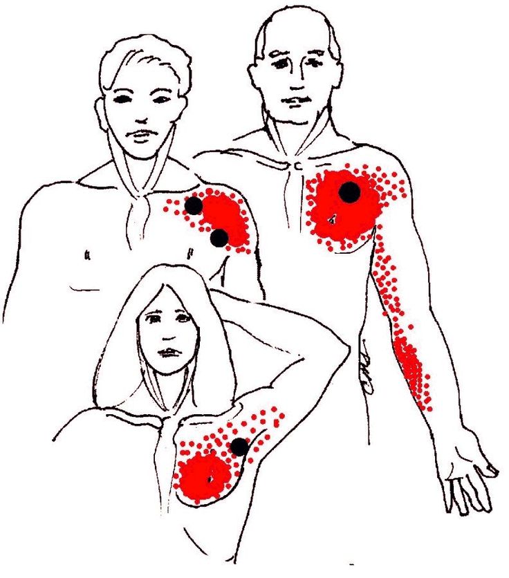 coracoid impingement Punkty Spustowe, Neck And Shoulder Exercises, Sports Massage Therapy, Round Earth, Trigger Point Therapy, Shoulder Pain Relief, Neck And Shoulder Pain, Therapeutic Massage, Trigger Points