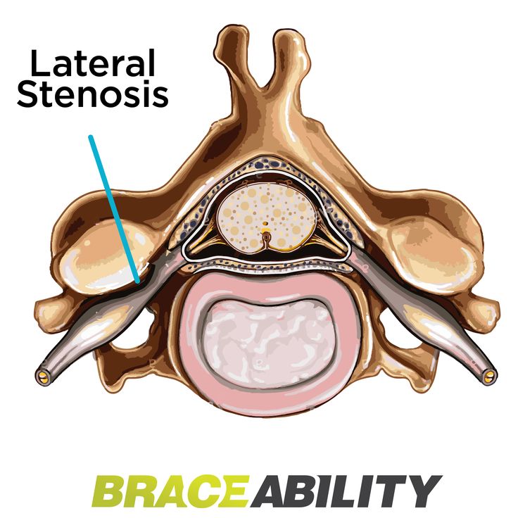 an image of the inside of a person's head with text that reads, lateral stenosiss