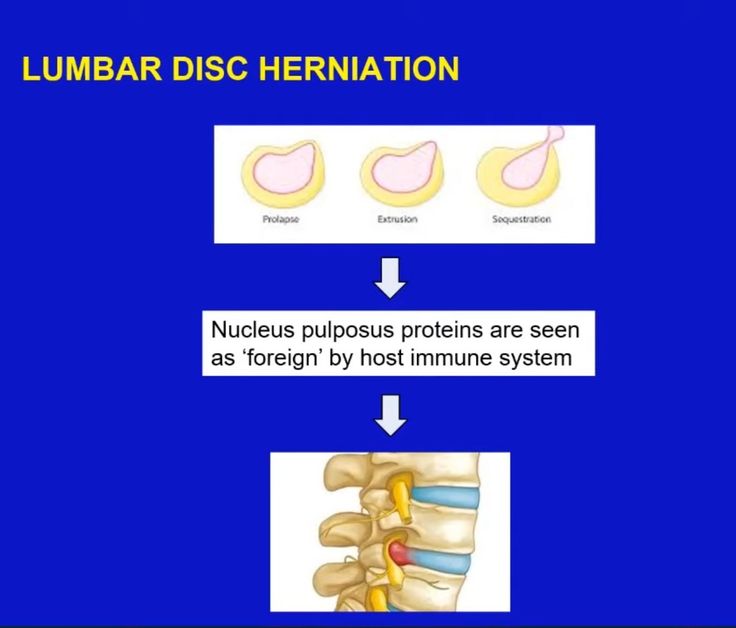 Nerve Root Blocks in Low back Pain