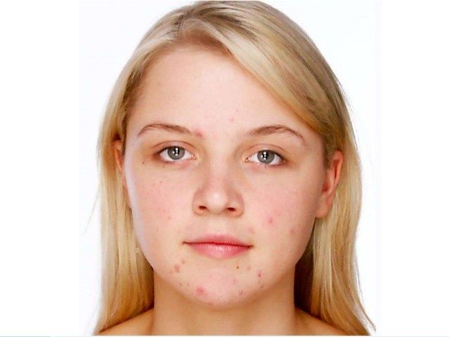 Smoothen Face Skin, Remove Pimples and Blemishes in Photoshop | Healing Brush Tool | Patch Tool Photoshop Practice Images, Pimple Face, Models Without Makeup, Woman Face Photography, Remove Pimples, Pimples On Face, Face App