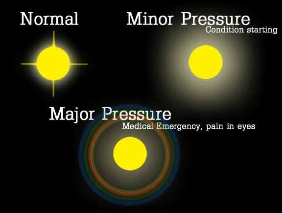 True or False? Seeing 'halos' around lights is normal? False...If you're seeing halos around lights, it could be a normal variation in your eye, such as the shape of your cornea. Eyeglasses or contacts may even cause halos, which your eye doctor can usually fix with changes in your prescription. But halos can be a sign of several eye problems. Some of the most common: cataracts...where your vision gets cloudy. Eye Problems, True Or False, Eyes Problems, Eye Doctor, Shape Of You, Emergency Medical, Health Info, A Sign, The Shape