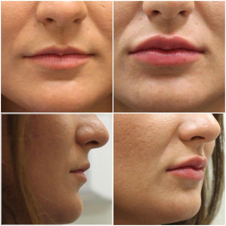 The methodology of concerning lips by techniques for secure ways. Lip augmentation Boston is that the scanning word for high appearance. Hydration Therapy, Makeup Wrinkles, Botox Before And After, Cover Wrinkles, Beauty Procedures, Small Mouth, Lip Augmentation, Injectables Fillers, Small Lips