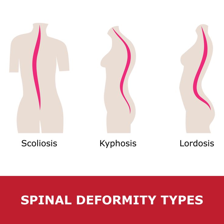 Swayback is often caused by lordosis; an abnormal inward curve of the lumbar spine. Lumbar Lordosis, Muscles Of The Neck, Lumbar Spine, Spine Health, Inflammation Causes, Medicine Student, Kinesiology Taping, Orthopedic Surgery, Knee Exercises