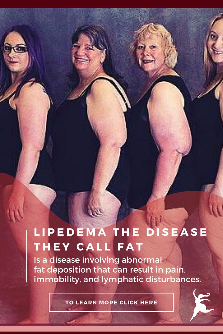 Lipedema is a relatively common fat disorder that is often mistaken for simple obesity. Its clinical diagnosis is an adipose tissue disorder or a lipid metabolism disorder. A typical lipedema patient is a woman who struggles with large hips and legs, usually out of proportion to the rest of her body. Lipedema also appears in the upper arms. One of the hallmarks of the disease is that lipedema fat is relatively unresponsive to standard diet and exercise. Lipedema Diet, Manual Lymph Drainage, Life Style Tips, Lipid Metabolism, Mastectomy Recovery, Lymph System, Lymph Drainage, Adipose Tissue, Weight Workout Plan