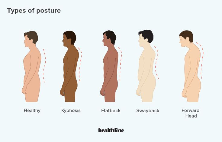 Types of Posture: How to Correct Bad Posture Types Of Posture, How To Correct Bad Posture, Bad Posture Reference, Perfect Posture Aesthetic, Good Posture Aesthetic, Forward Head Posture Correction, Correct Bad Posture, Posture Drawing, Forward Head Posture Exercises