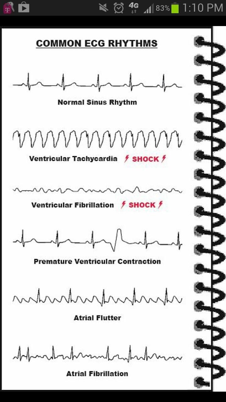 Ecg Abnormalities Chart Understanding The Heart Health Indicators Of ...