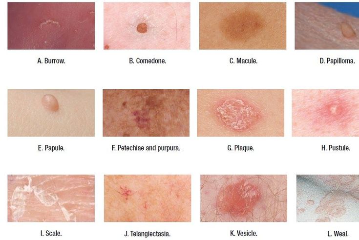 Types of Skin Lesions | Medical Addicts ... Hidden Illness, Colour Scale, Dermatology Nurse, Hygiene School, Skin Lesions, Nursing Assessment, Integumentary System, Family Nurse Practitioner, Best Nursing Schools