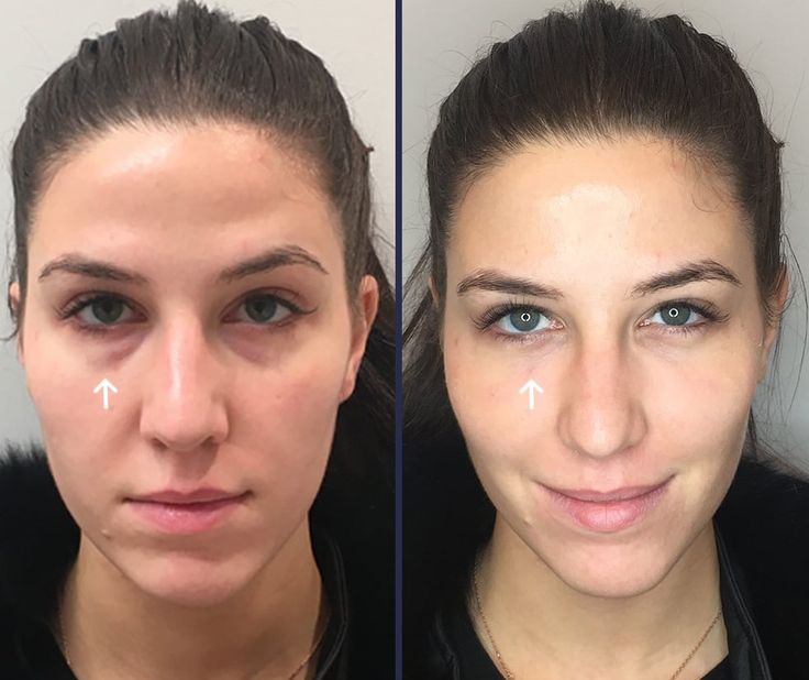 Under Eye Fillers for Dark Circles: Efficacy, Photos, Cost, Side Effects Nasolabial Folds Dermal Fillers, Under Eye Filler, Dark Undereyes, Reduce Eye Bags, Under Eye Fillers, Tear Trough, Permanent Makeup Eyebrows, Botox Fillers, Doe Eyes