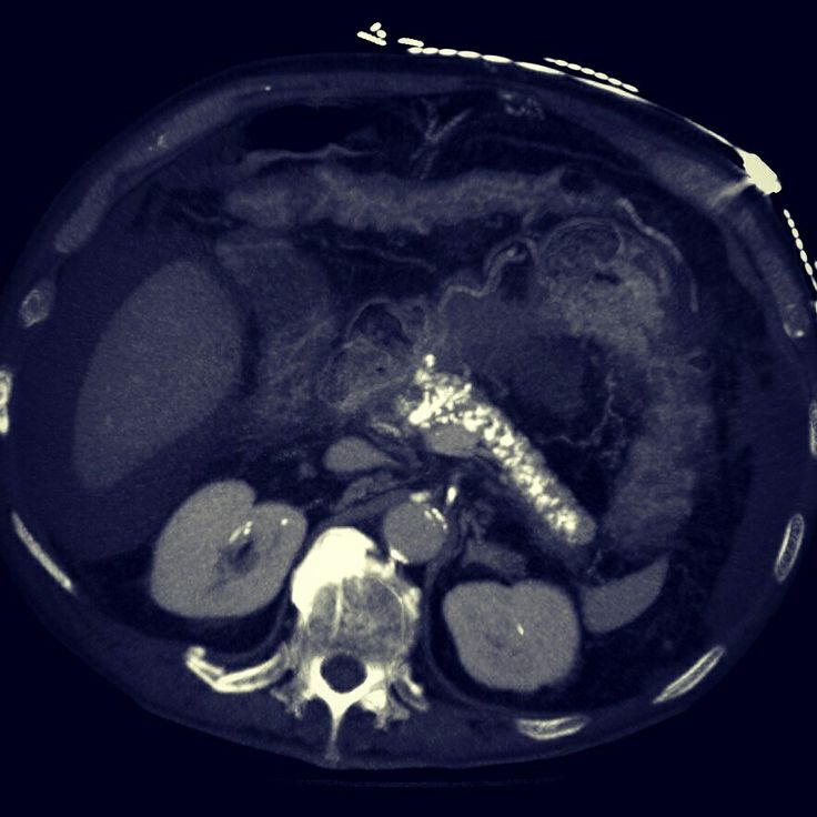 Heavy calcification in pancreas due to chronic pancreatitis. Ascites. Renal calcification.   #foamrad #FOAMed #radiology Radiology, Medicine, Medical