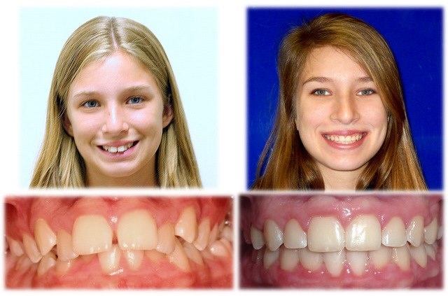 Before and after pics of patient treated for overbite...you can see the extreme change in her profile... Overbite Before And After, Before And After Pics, Before And After Pictures, Change In, Nursing School, Braces, Nursing, Canning, Quick Saves