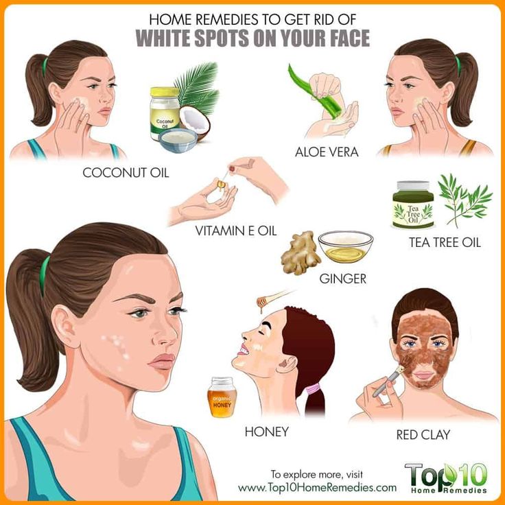 Get rid of white spots on face #ExfoliatingFaceScrub White Spots On Face, White Spots On Skin, White Skin Spots, Spots On Skin, Back Acne Remedies, Skin Spots, Spots On Face, Flexible Dieting, Autoimmune Disorder