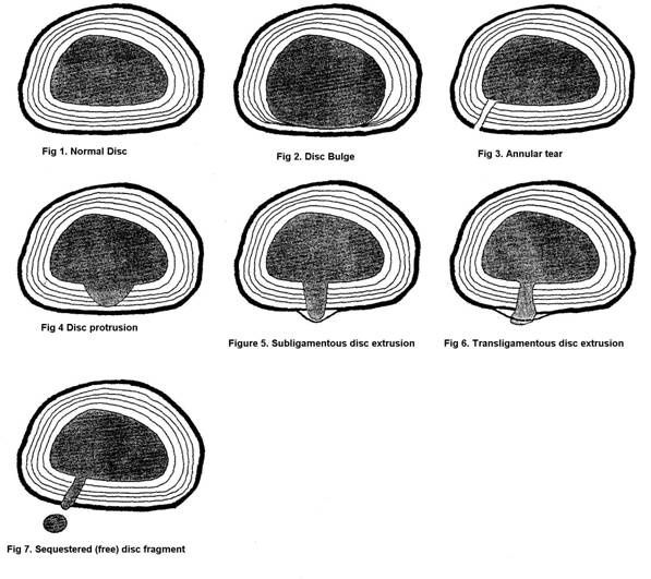 disc bulge with annular tear - Google Search Trapped Nerve, Causes Of Back Pain, Bulging Disc, Spinal Surgery, Pinched Nerve, Tight Hip Flexors, Psoas Muscle, Spine Surgery, Brain Surgery