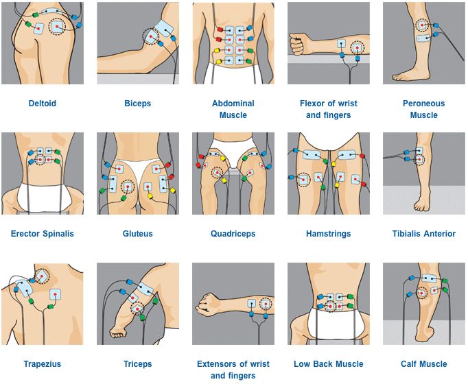 https://s-media-cache-ak0.pinimg.com/originals/95/b6/37/95b6371b9192f1740e466ce933b4d528.gif Tens Placement, Tens Electrode Placement, Tens Unit Placement, Tens And Units, Tens Machine, Tens Unit, Tens Ems, Ten Unit, Muscle Stimulator