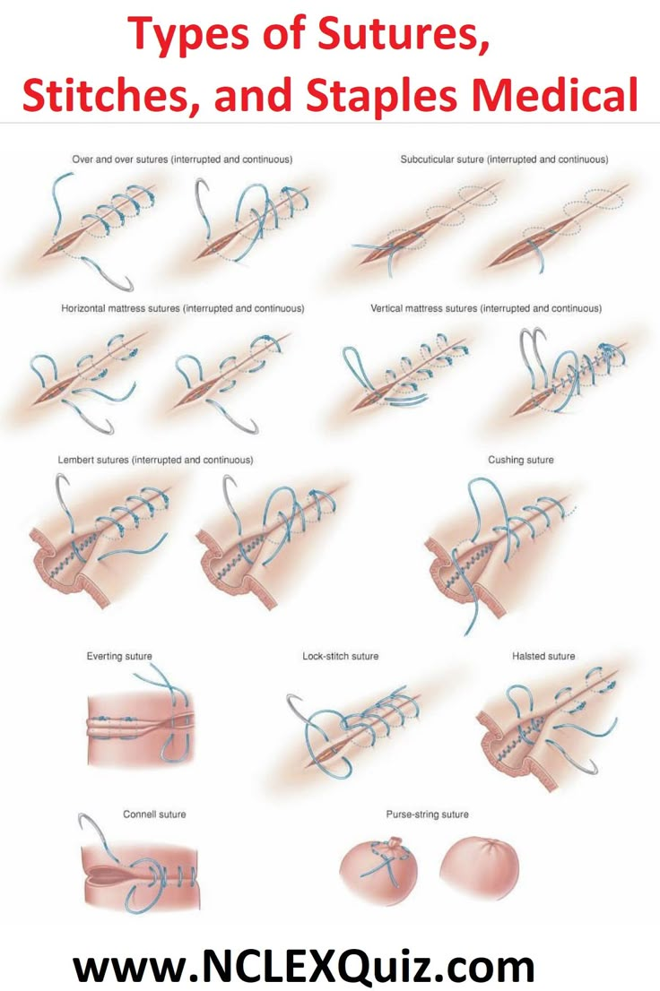 an image of different types of surgery on a cell phone with the caption's description below