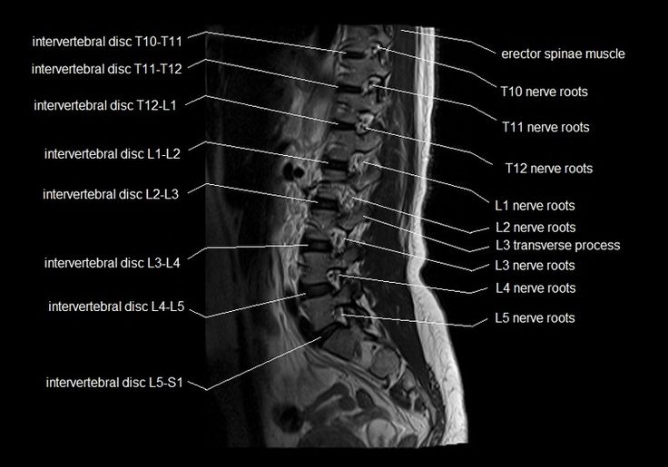 MRI spine anatomy | free MRI lumbar spine sagittal cross sectional ...