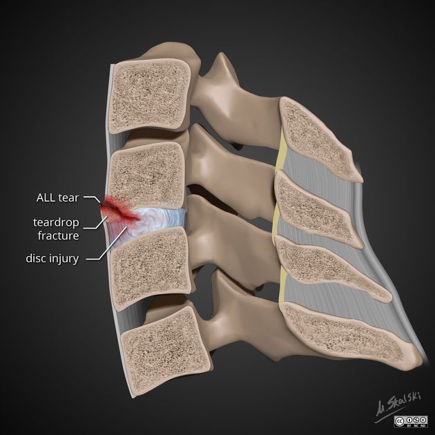 Extension tear drop fracture | Radiology Reference Article ...