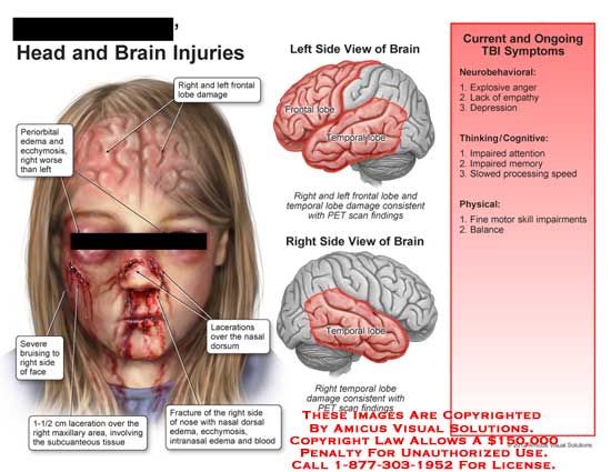 Any severe damage to the frame could have full-size ant lasting effects. However, worrying mind injuries deliver with them a fair greater profound set of challenges. This is proper due to the fact … Medical Slp, Frontal Lobe, Narcissistic Personality, Injury Recovery, Chronic Illness, Brain, Health Care, Medical, Signs