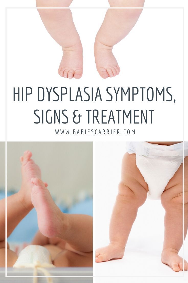 baby's legs and feet with the words hip dysplasia symptoms signs