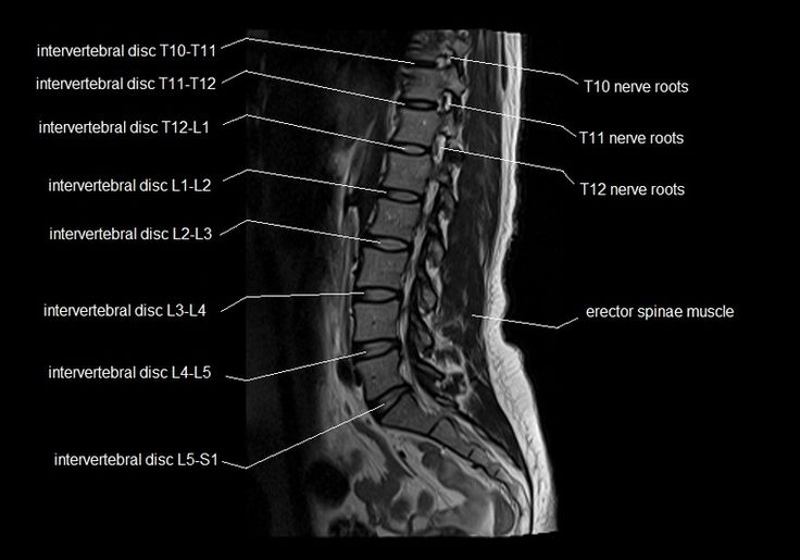 MRI spine anatomy | free MRI lumbar spine sagittal cross sectional ...