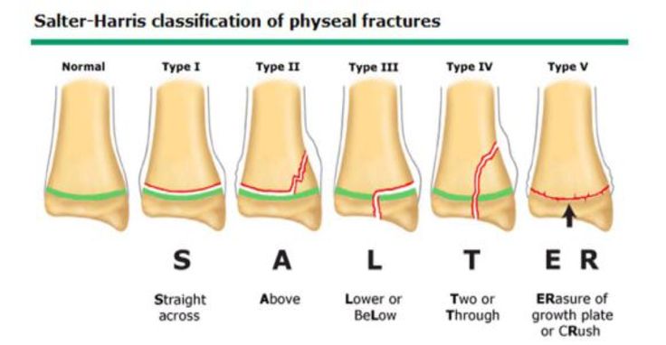 different types of feet and ankles with the words salt - harris classificfication