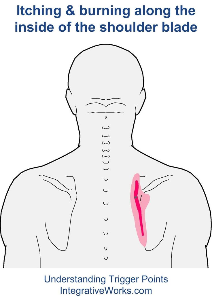 oitf-trapeziusIntegrative Works | Integrative Works Psoas Release, Mid Back Pain, Rotator Cuff Injury, Shoulder Pain Relief, Upper Back Pain, Neck And Shoulder Pain, Qi Gong, Body Pain, Acupressure Points