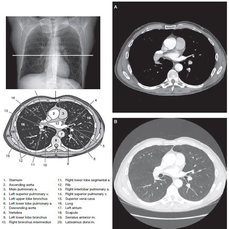 an x - ray shows the chest, lungs and other organ structures in this image