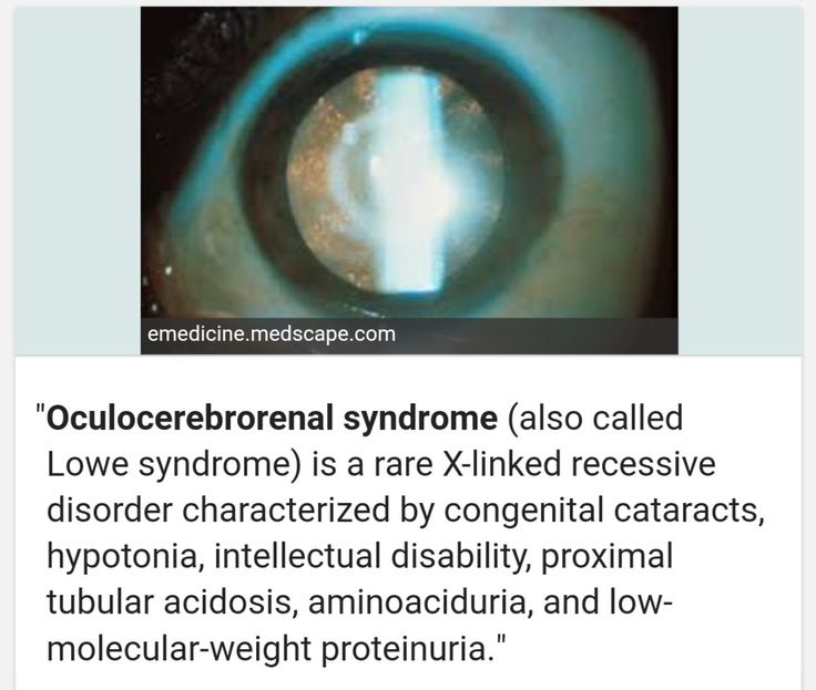 OcculoCerebroRenal syndrome / Lowe syndrome ... 【 Renal pathology is characterized by an abnormal loss of certain substances into the urine, including bicarbonate, sodium, potassium, amino acids, organic acids, albumin, calcium and L-carnitine, this problem, is known as Fanconi-type renal tubular dysfunction 】 ... Hypophosphatamic Rickets is its feature ... L Carnitine, Nurse Life, Amino Acids, Nursing, Medicine