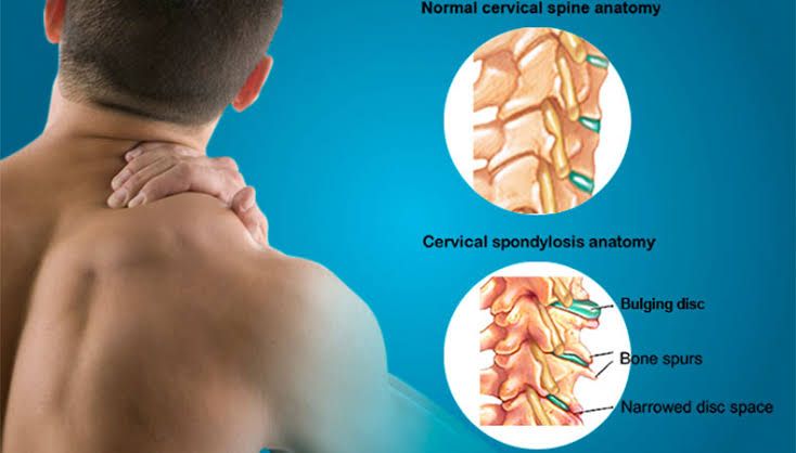 Cervical spondylitis | Cervical spondylosis, Cervical, Bulging disc