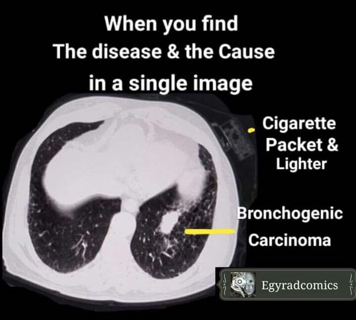 an x - ray shows the chest and lungs in black and white, with text describing when you find the disease & the cause in a single image