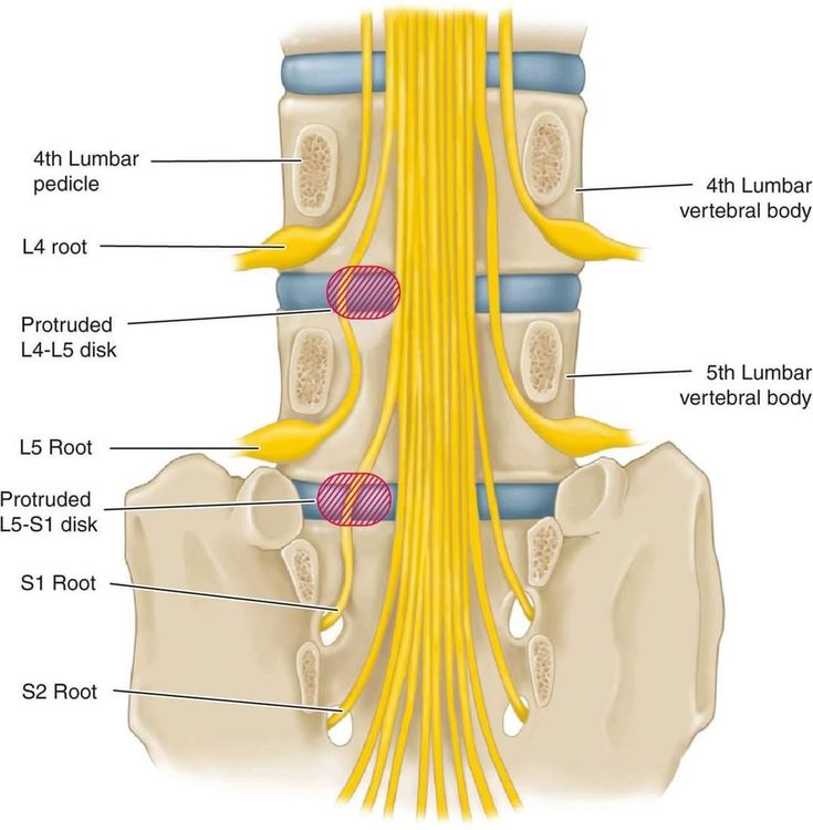 Nerve Root Blocks in Spine Surgery