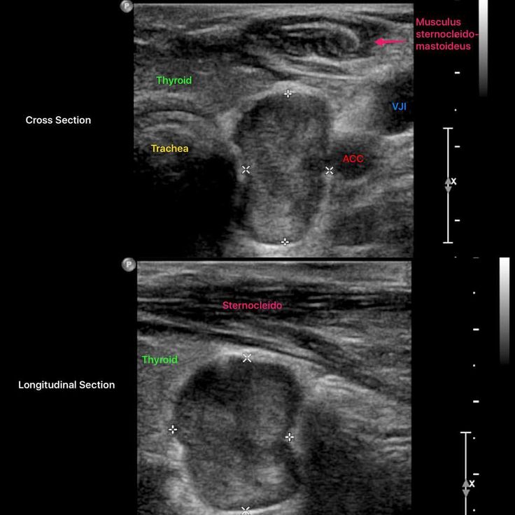 Parathyroid adenoma/hyperplasia in a patient on chronic hemodialysis. #ultrasound #sonography #FOAMus #radiology #nephpearls #kidney #renal… Ultrasound Anatomy, Thyroid Ultrasound, Ultrasound School, Obstetric Ultrasound, Grey Ink Tattoos, Vascular Ultrasound, Ultrasound Sonography, Mri Brain, Medical Sonography