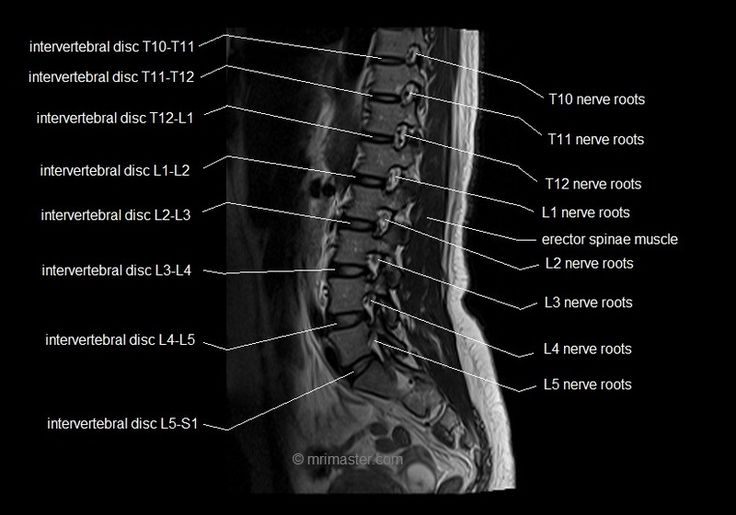 MRI spine anatomy | free MRI lumbar spine sagittal cross sectional ...