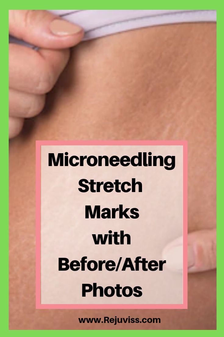 See these before and after photos after dermarolling stretch marks. The results are amazing! Strech Marks Removal, Derma Roller Before And After, Strech Marks, Derma Rolling, Tighten Loose Skin, Stretch Mark Removal, Stretch Mark, Before After Photo, Derma Roller