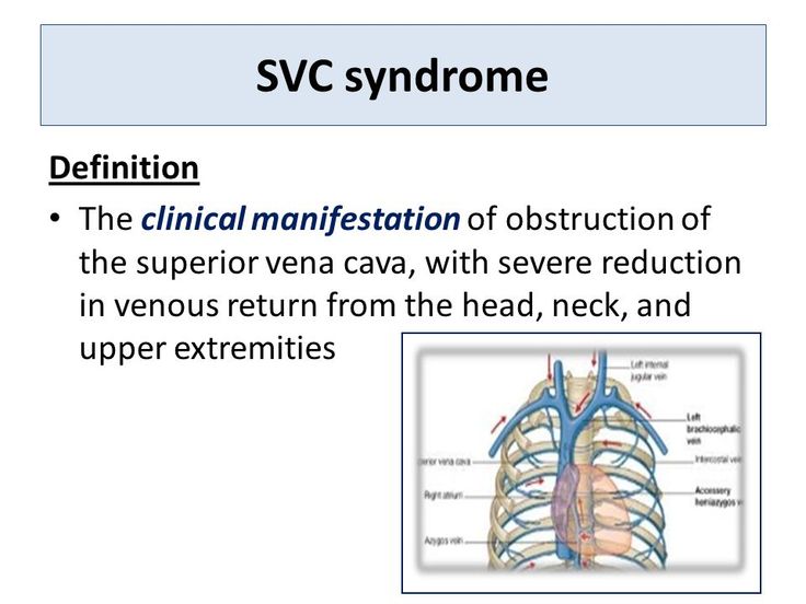 Radiotherapy For Svc Syndrome Ppt Video Online Download Syndrome Health Education Chemotherapy