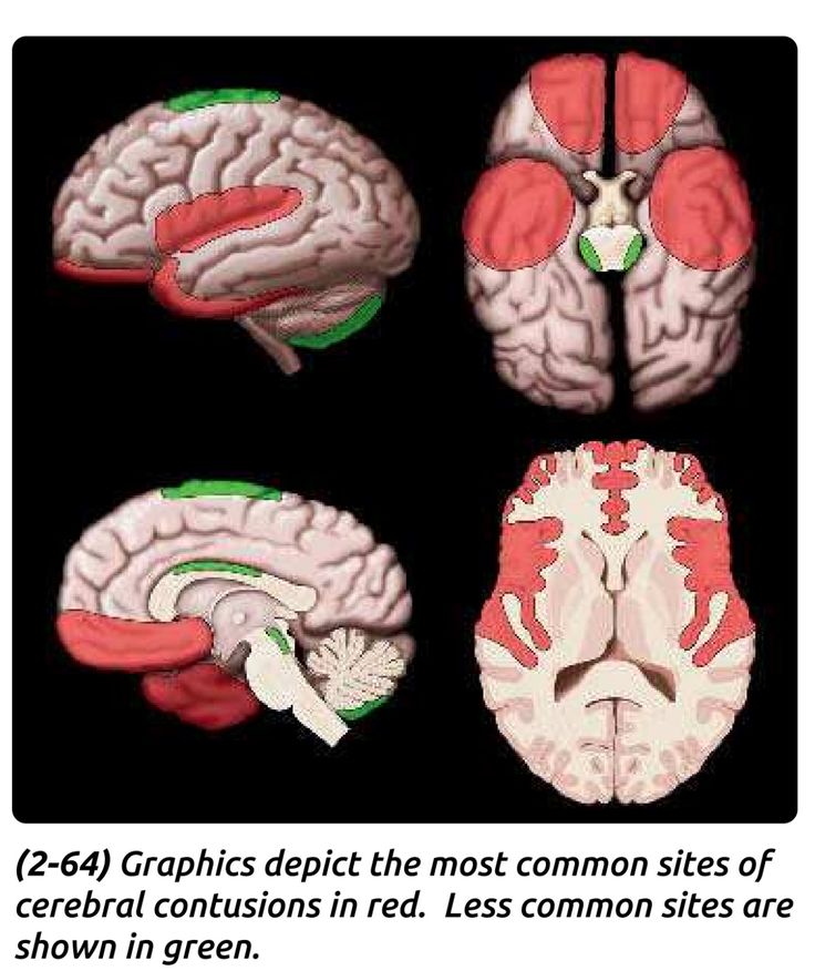 four different views of the human brain, each with red areas on their left and right sides