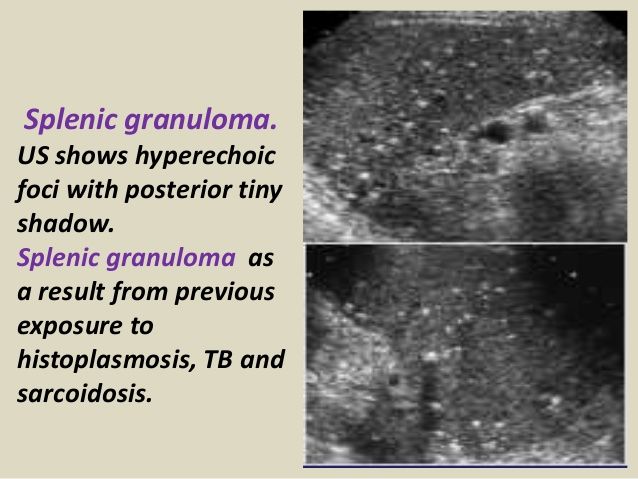 Splenic granuloma. US shows hyperechoic foci with posterior tiny shadow ...