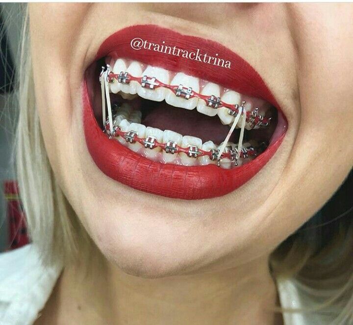 #Braces Braces Red Braces Teeth, Red Braces Aesthetic, Red Braces Color, Power Chain Braces, Braces Colors Combinations, Invisible Teeth Braces, Red Braces, Braces Colors Ideas, Braces Smile